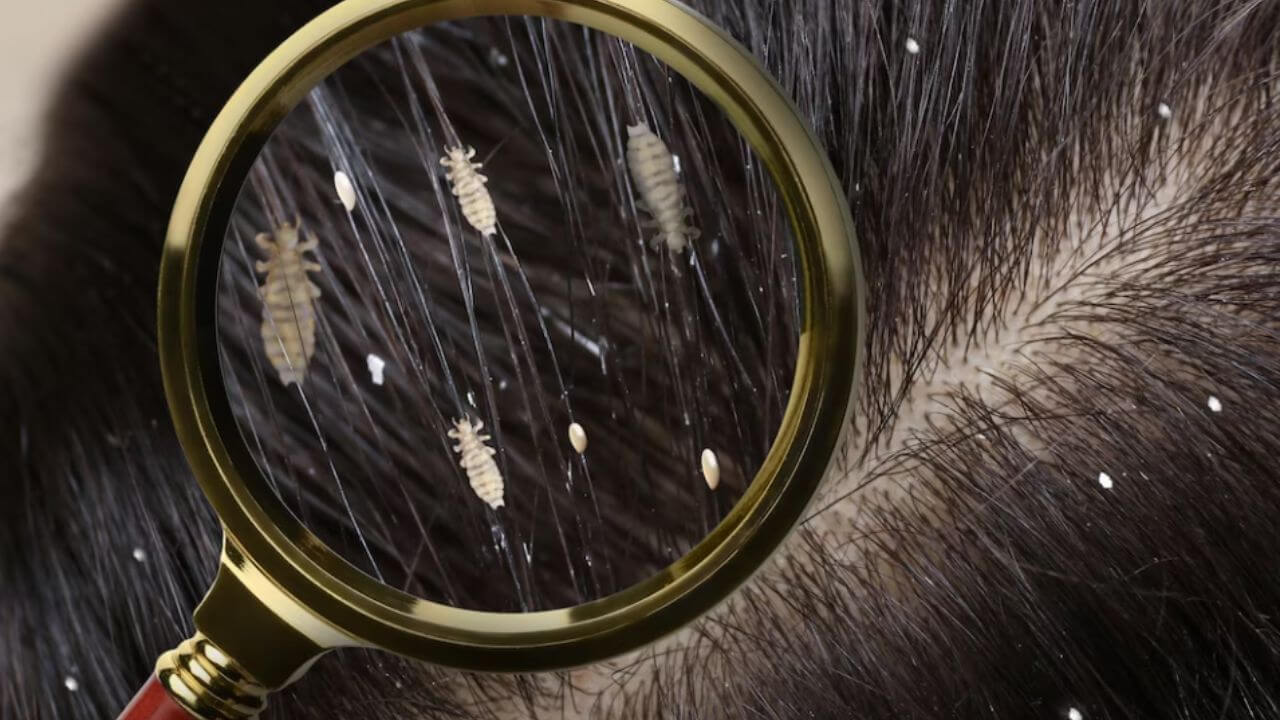 तुमच्याही मुलांच्या केसांत उवा झालेत? समस्या दूर करण्यासाठी करा घरगुती उपाय