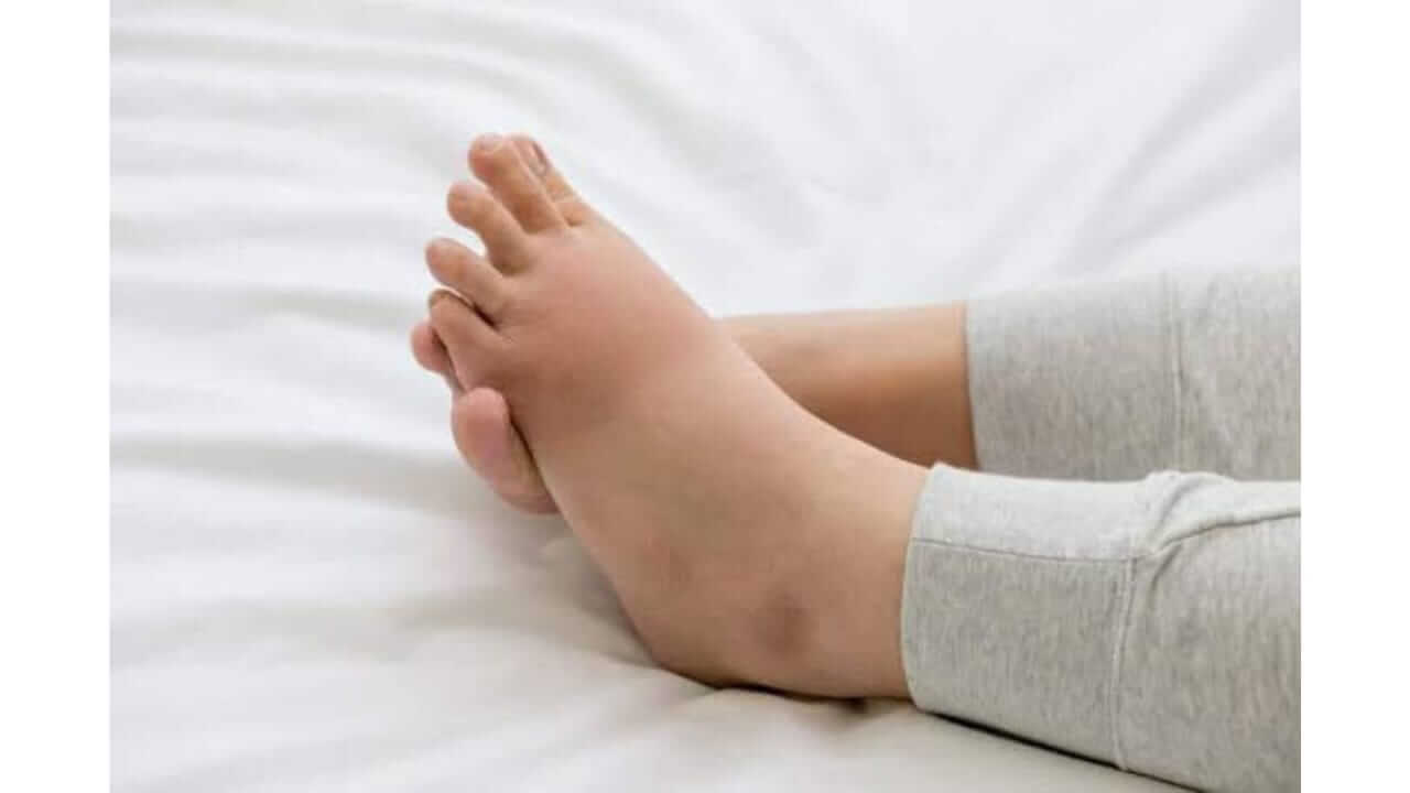 पायांना सूज येणे असू शकते ‘या’ गंभीर आजारांचे लक्षण, जाणून घ्या