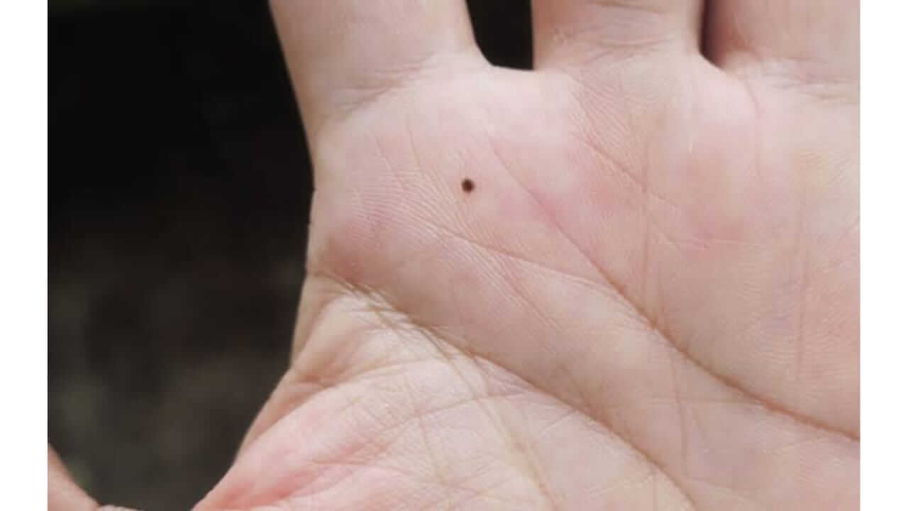 तळहातावरील तीळ काय सांगतो? जाणून घ्या