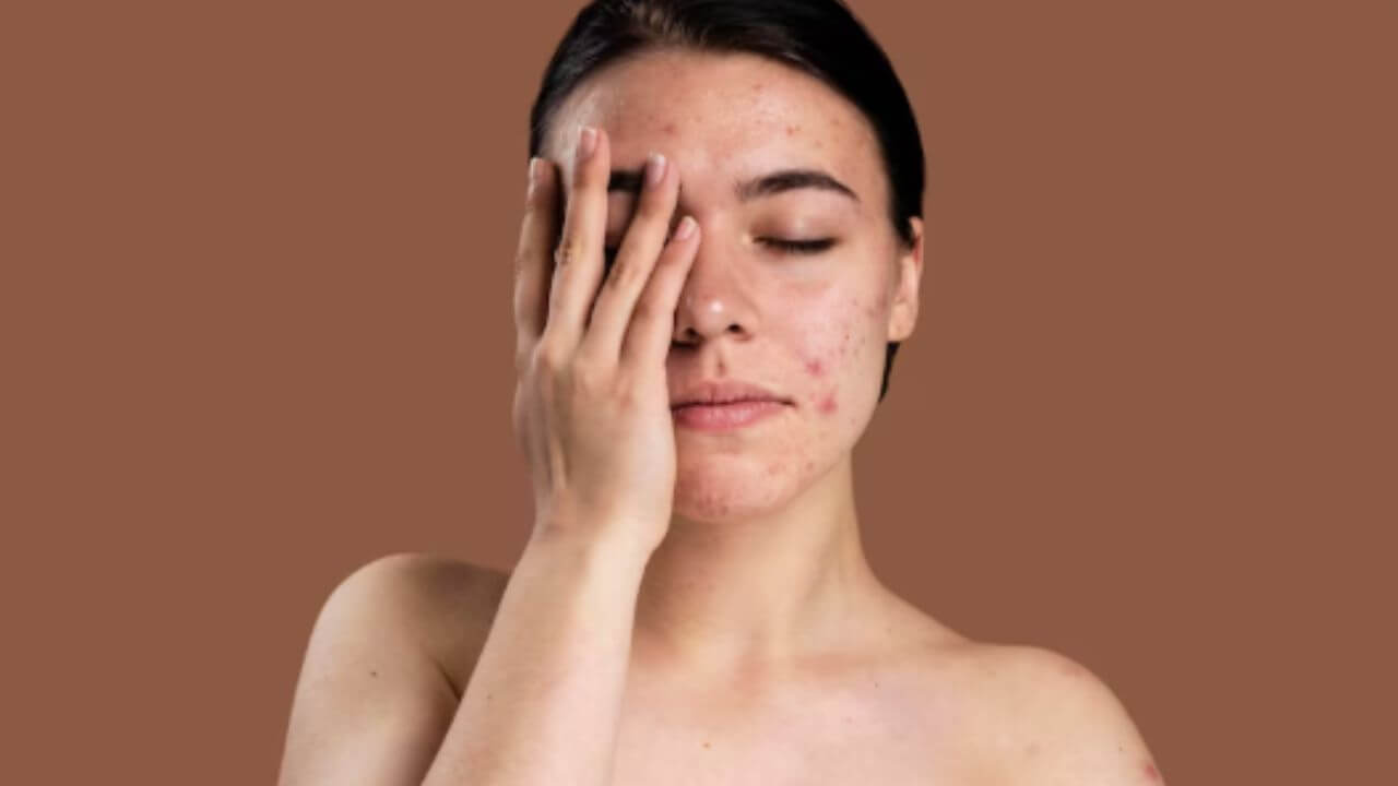 पिंपल्समुळे चेहऱ्यावर खड्डे आणि डाग पडलेत? 'हे' घरगुती उपाय गुळगुळीत बनवतील चेहरा