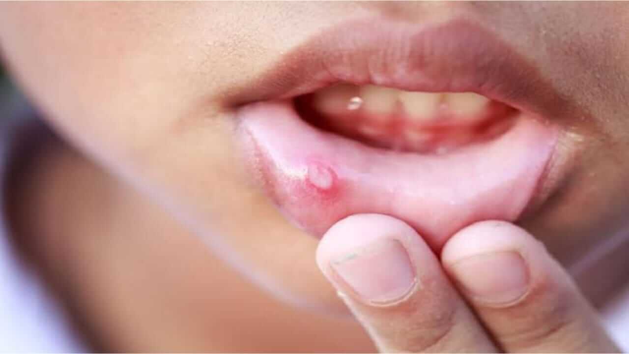तोंडात वारंवार फोड येण्याने त्रास होत असेल; तर, 'हे' घरगुती उपाय करून पाहा