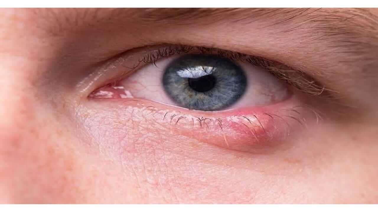 रांजणवाडी का होते? जाणून घ्या कारणे, लक्षणे आणि उपाय...