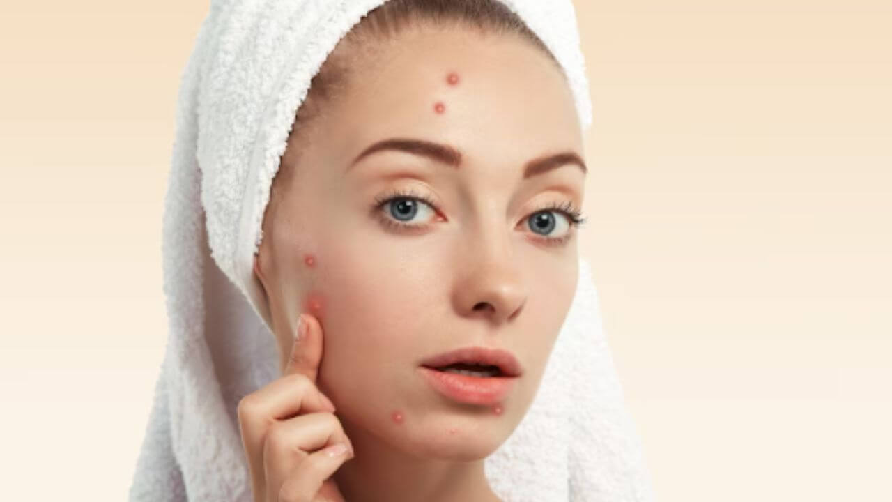 चेहऱ्यावर सतत पिंपल्स येऊन डाग पडतात? 'हे' घरगुती उपाय देतील नितळ त्वचा