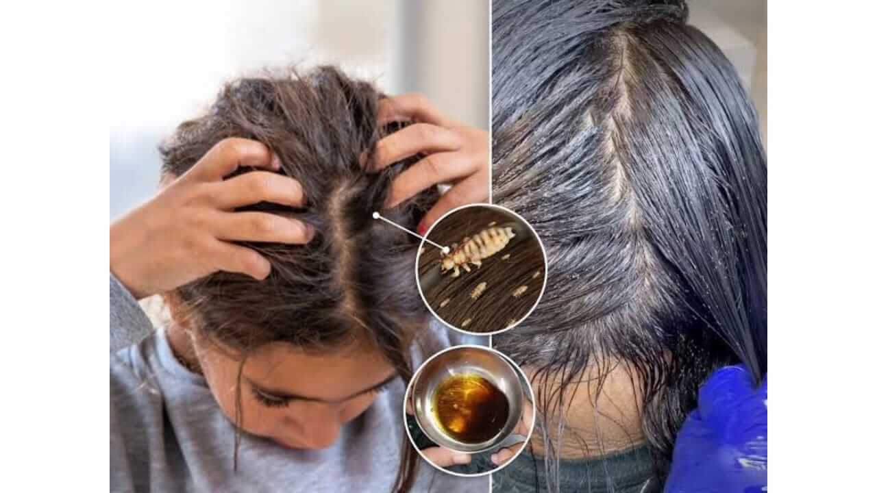 पावसाळ्यात केसांमधील उवांमुळे हैराण झाला आहात? 'हे' घरगुती उपाय करून पहा